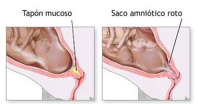 Cuando se expulsa el tapon mucoso